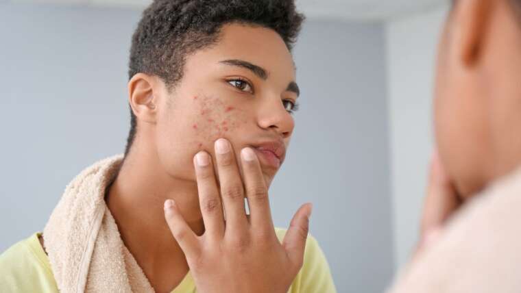 Vitamina D acne: descubra como essa vitamina pode ajudar na pele